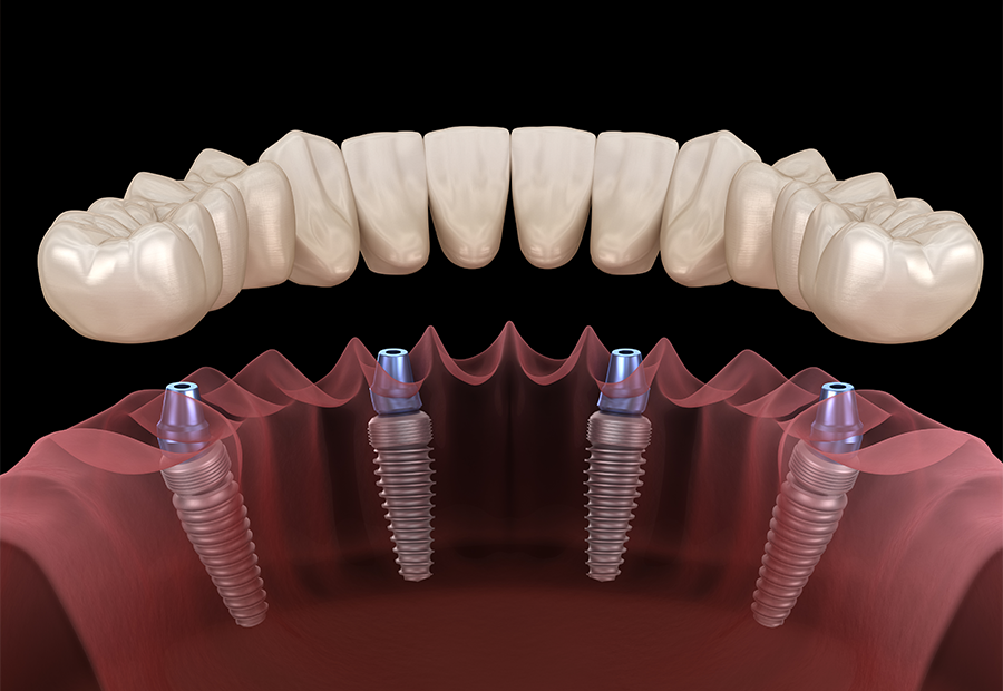 All On Four Implant
