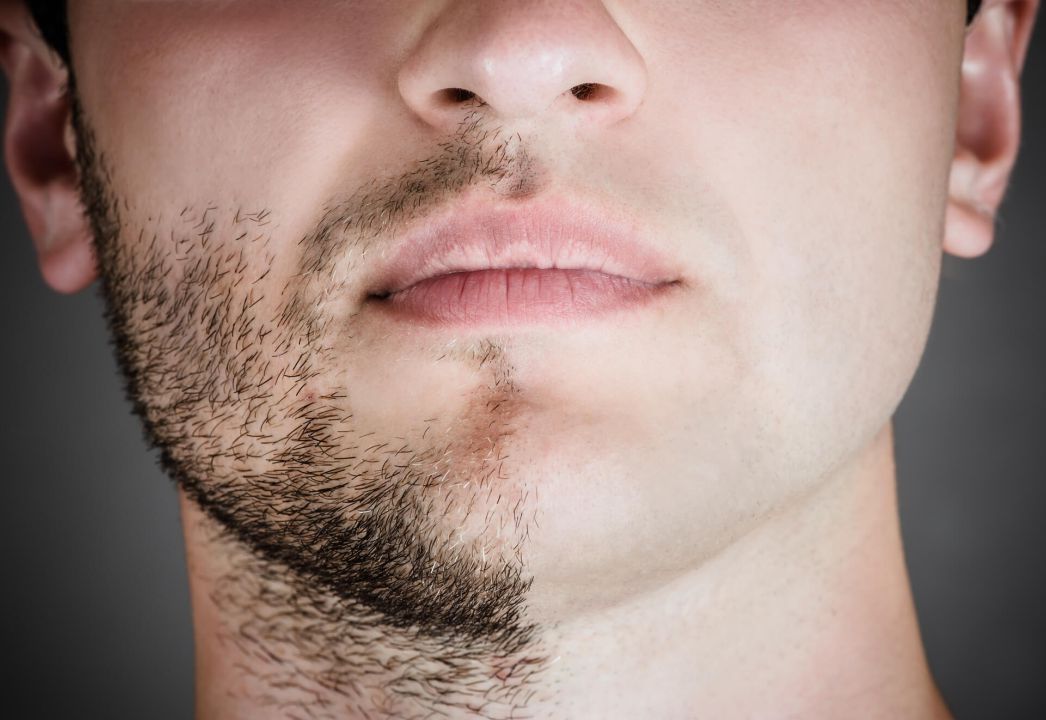 Beard and Mustache Transplant