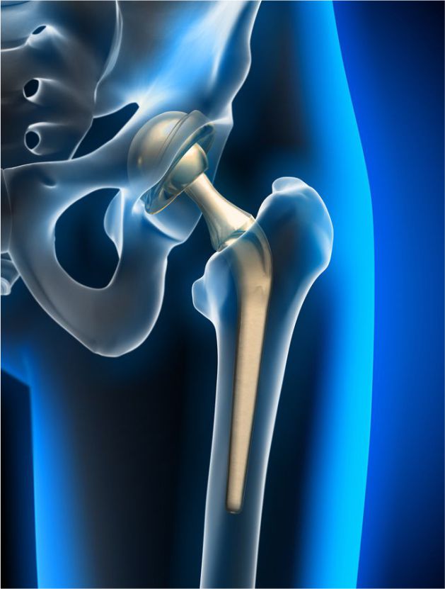 Orthopedic prostheses