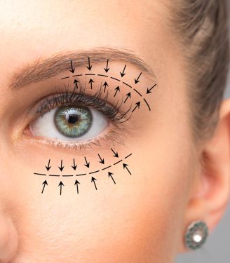 Upper and Lower Eyelid Surgery 