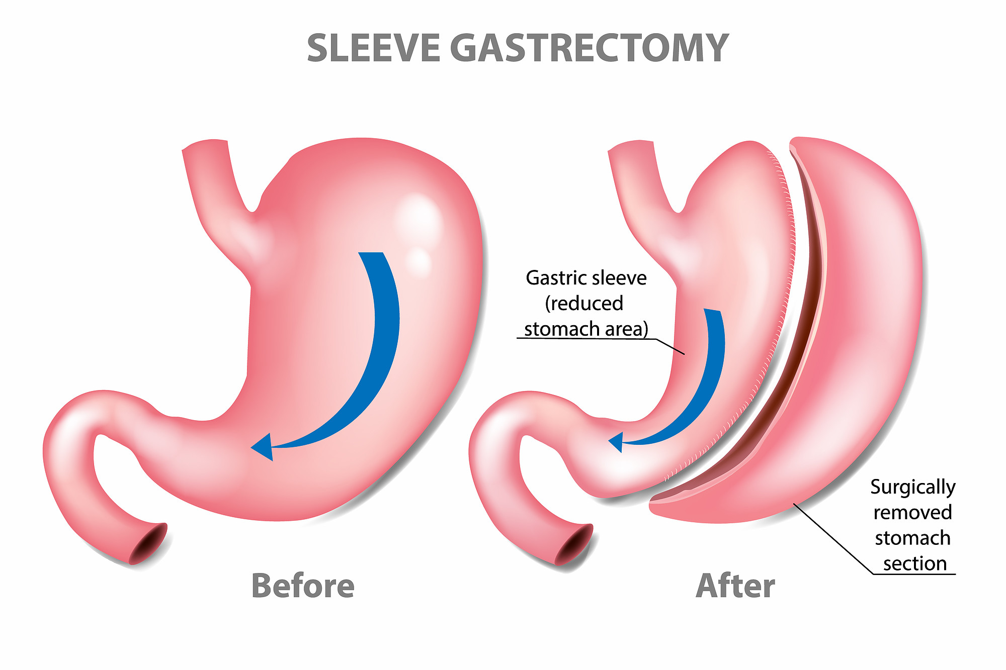 What is a Gastric Sleeve? 